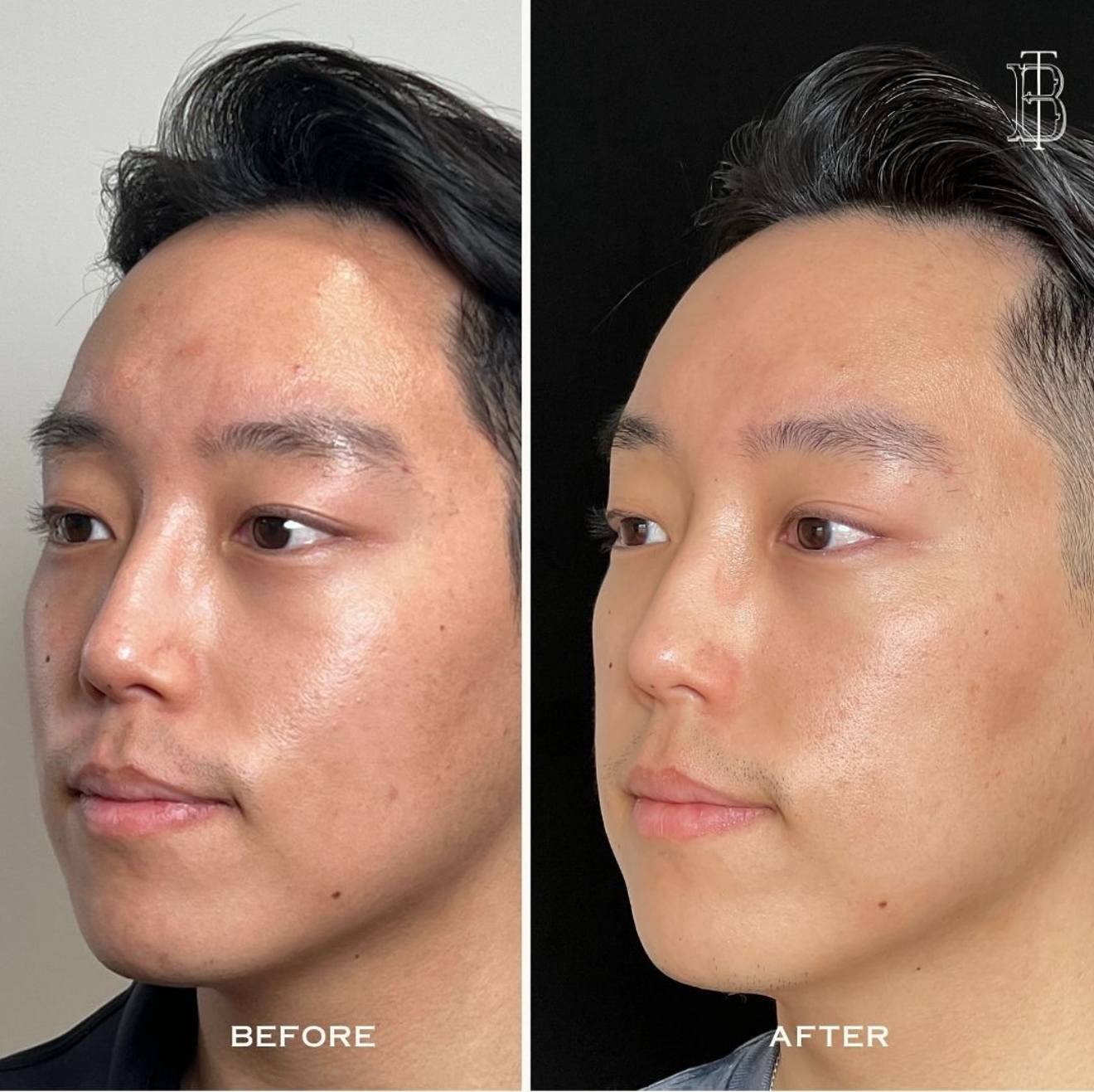 Microneedling With PRP: Package of Three