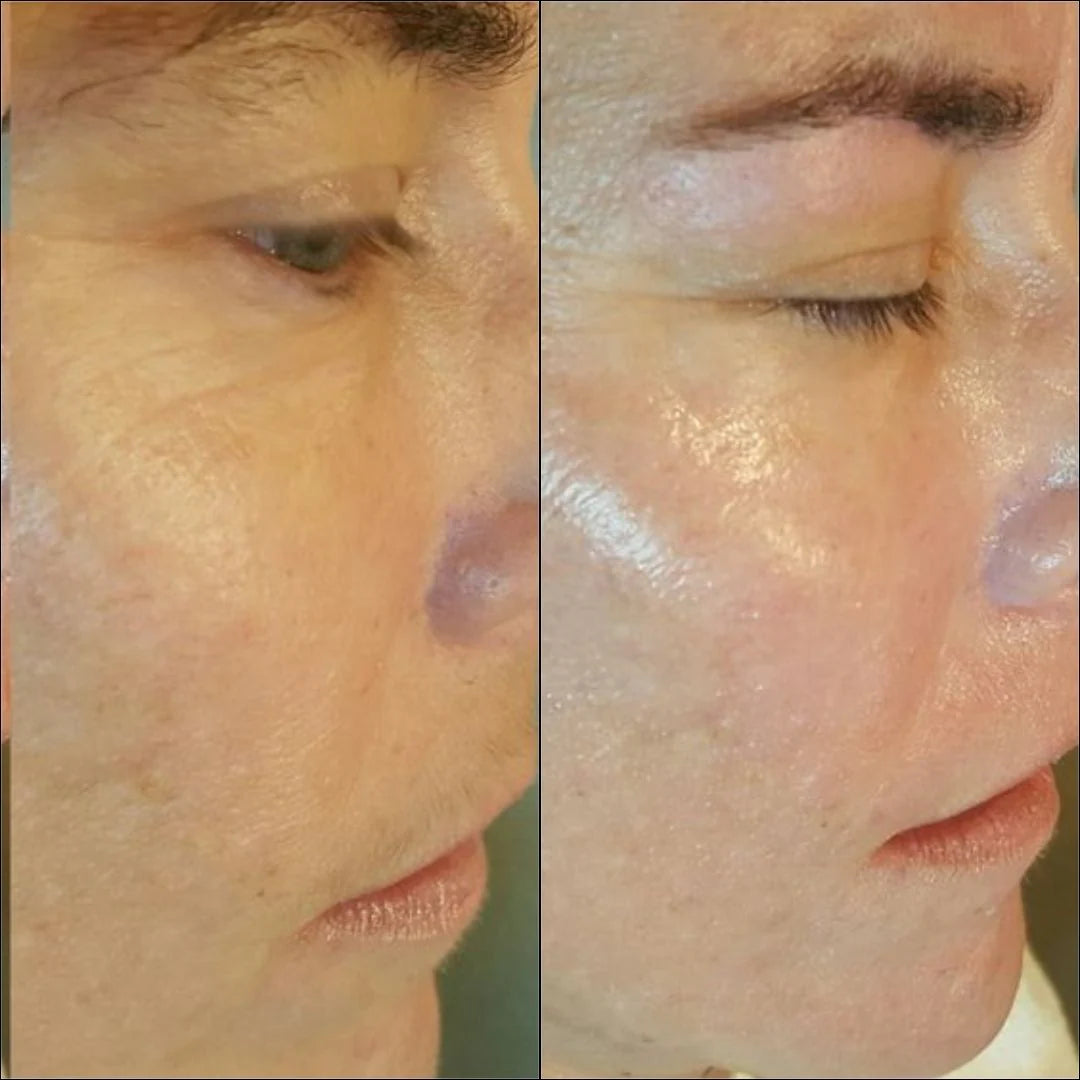 Dermaplaning Facial: BUY 2 GET 1 FREE