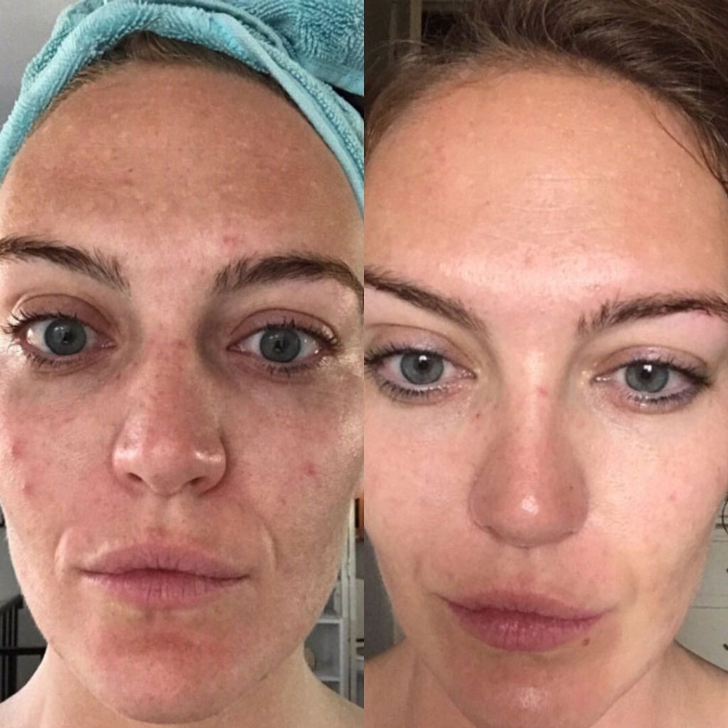 Microneedling
