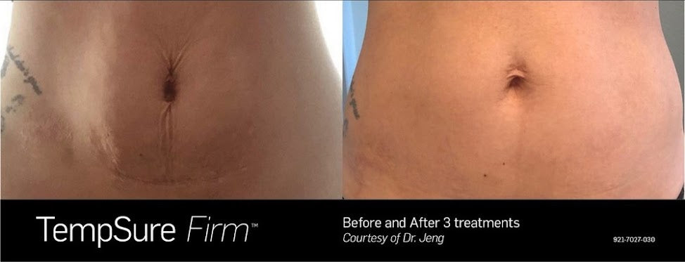 Tempsure Firm: Body Tightening