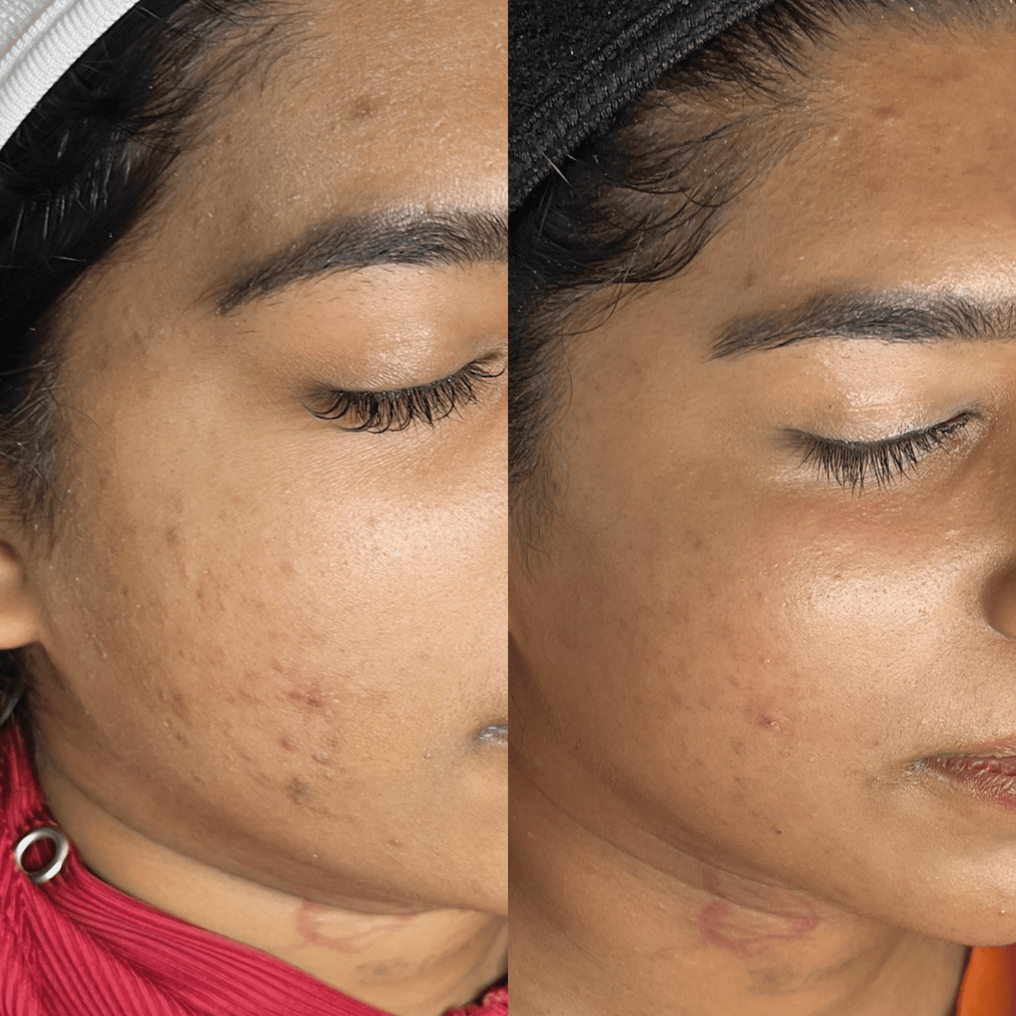 Microneedling With PDRN