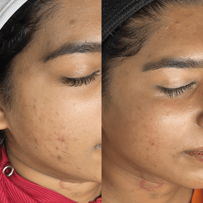 Microneedling With PDRN