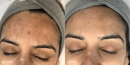Microneedling With PDRN