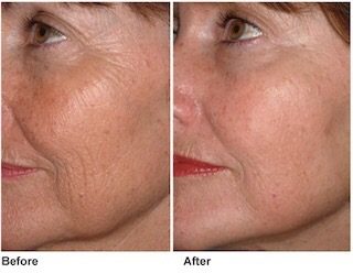 Fire & Ice: Facial Peel Hybrid 25%+ OFF