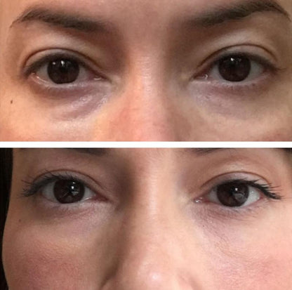 Under Eye PRP