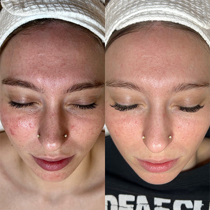 Microneedling