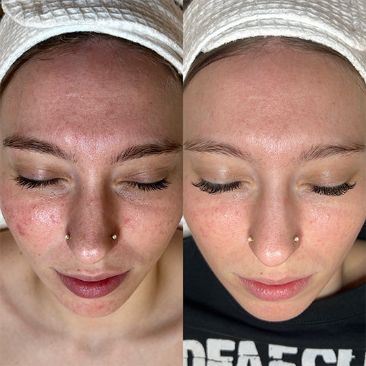 Microneedling