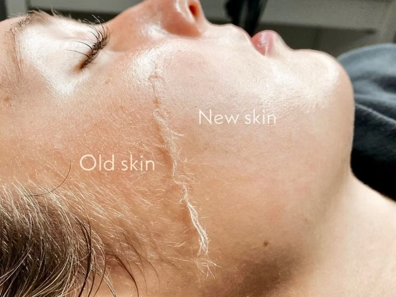 Dermaplaning Facial: BUY 2 GET 1 FREE