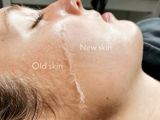 Dermaplaning Facial: BUY 2 GET 1 FREE
