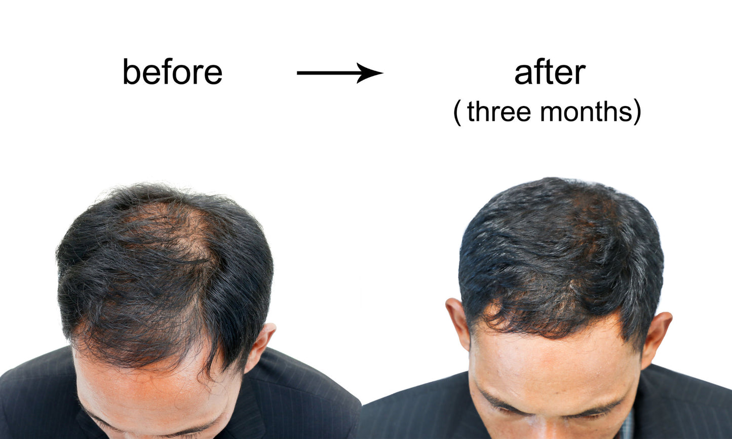 PRP Hair Restoration