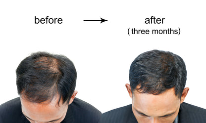 PRP Hair Restoration