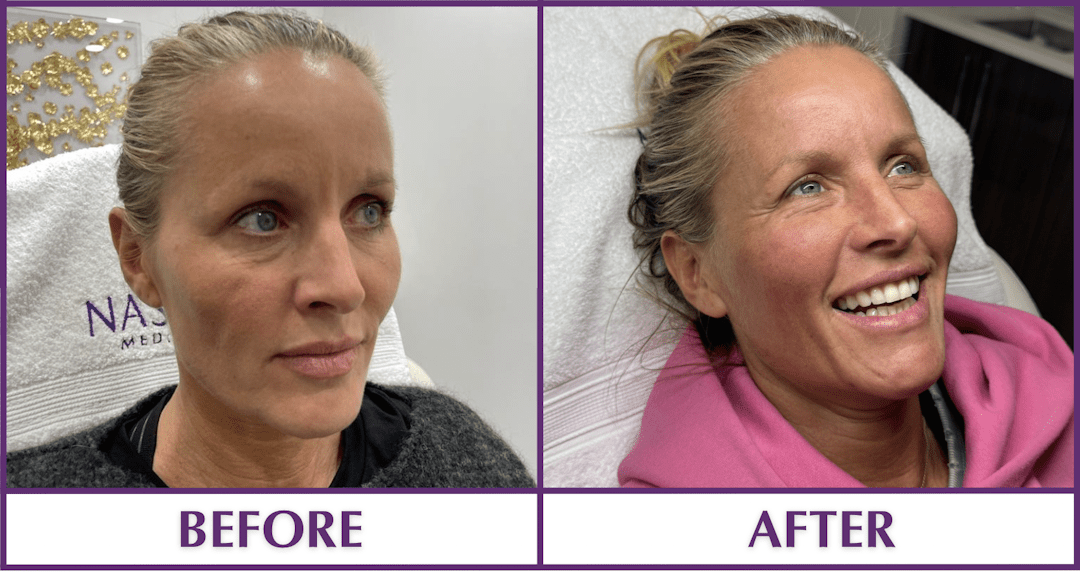 PRP Facelift