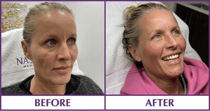 PRP Facelift