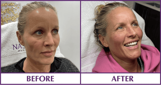 PRP Facelift