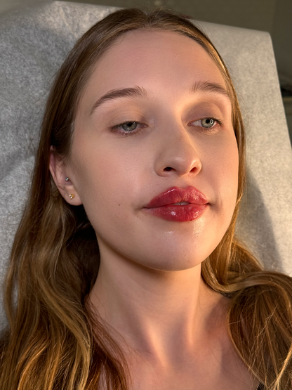 Lip Filler 1/2 Syringe