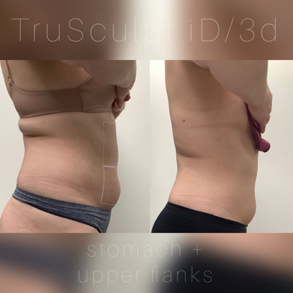 Trusculpt - 45% OFF