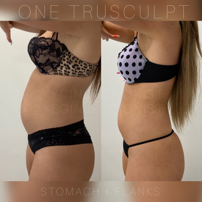 Trusculpt - 45% OFF