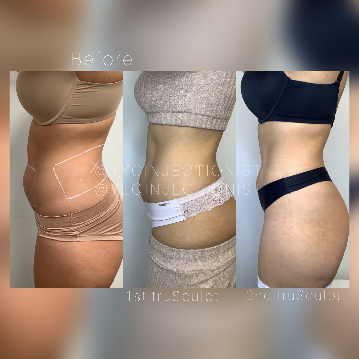 Trusculpt - 45% OFF