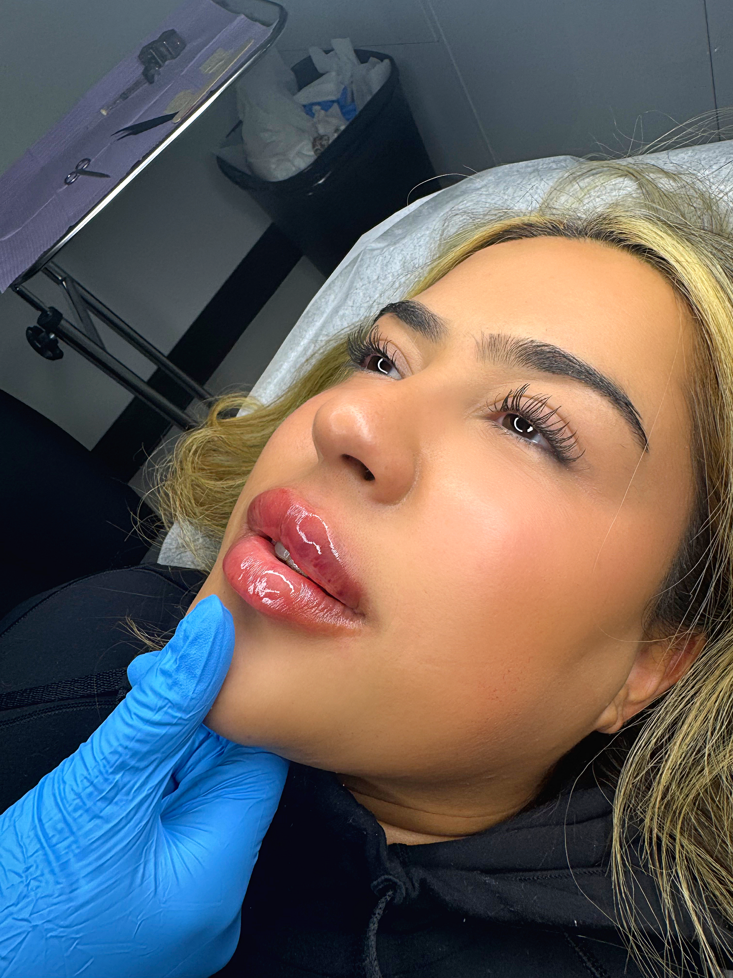 Lip Filler Full Syringe