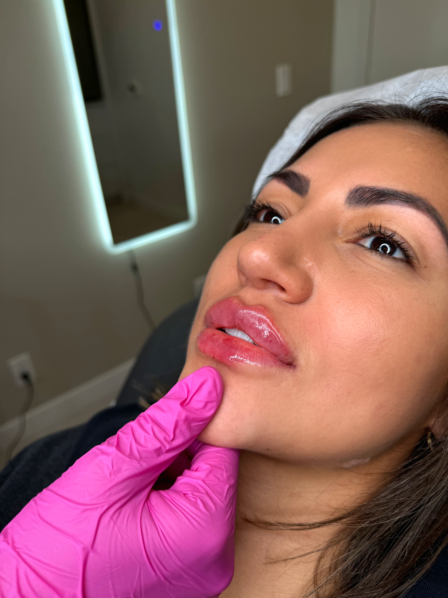 Lip Filler Full Syringe