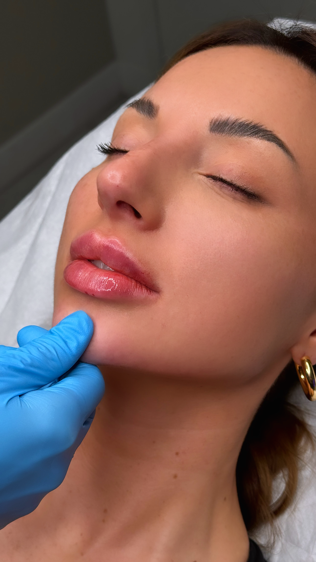 Lip Filler Full Syringe