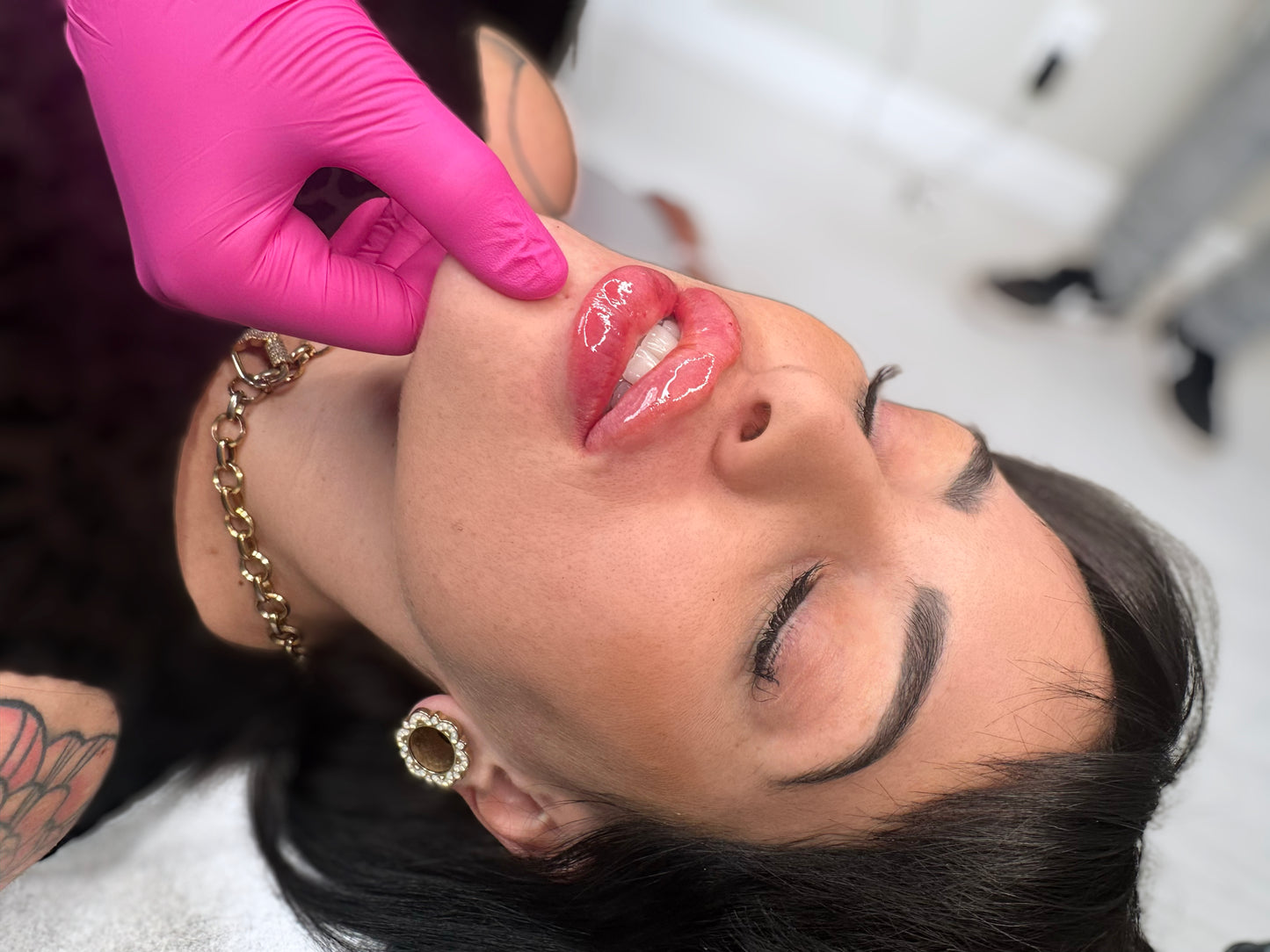 Lip Filler Stripp Lips