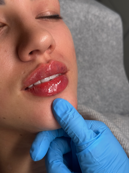 Lip Filler Full Syringe