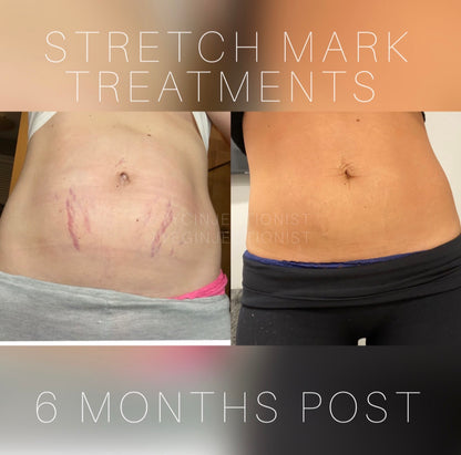 Microneedling