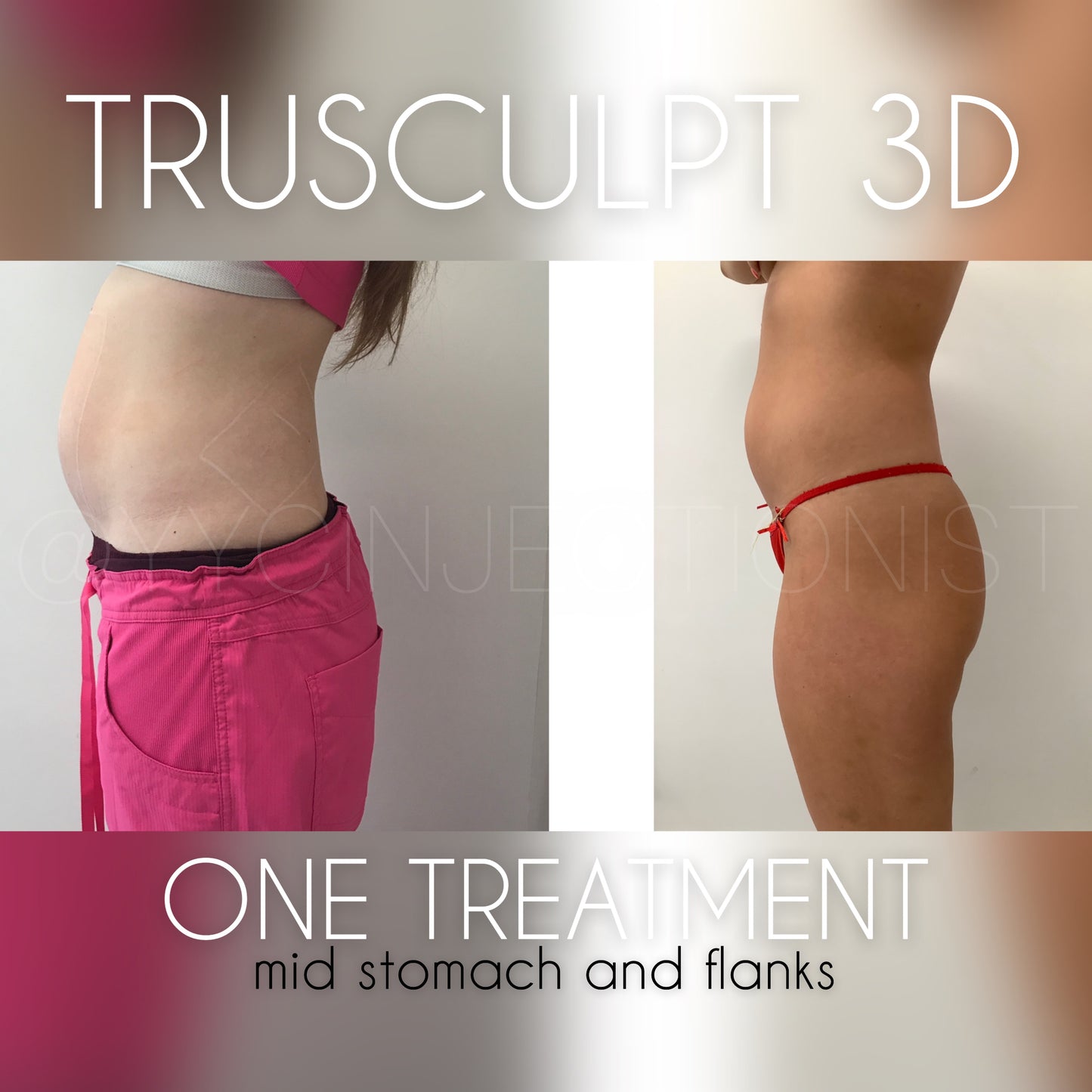 Trusculpt - 45% OFF