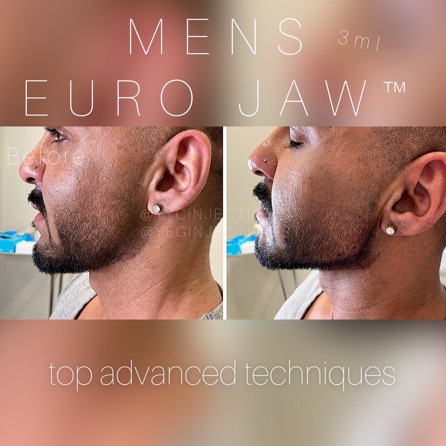 6ML Masculinization Package