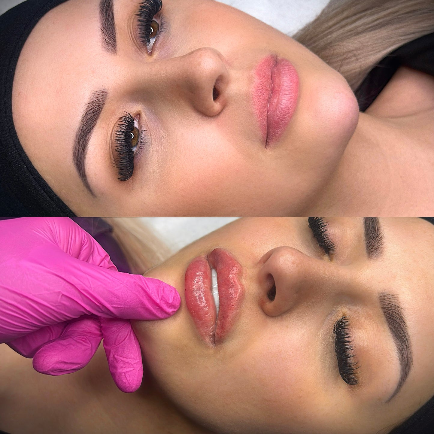 Lip Filler 1/2 Syringe