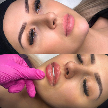Lip Filler 1/2 Syringe