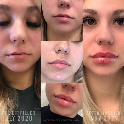 Lip Filler Full Syringe
