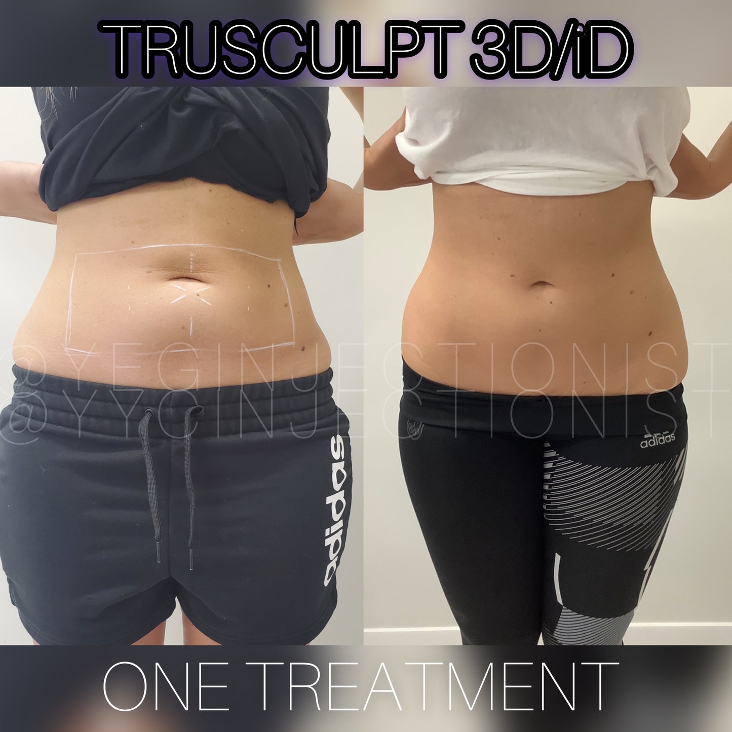 Trusculpt - 45% OFF