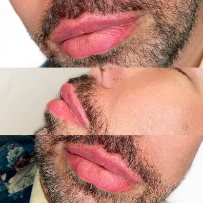 6ML Masculinization Package
