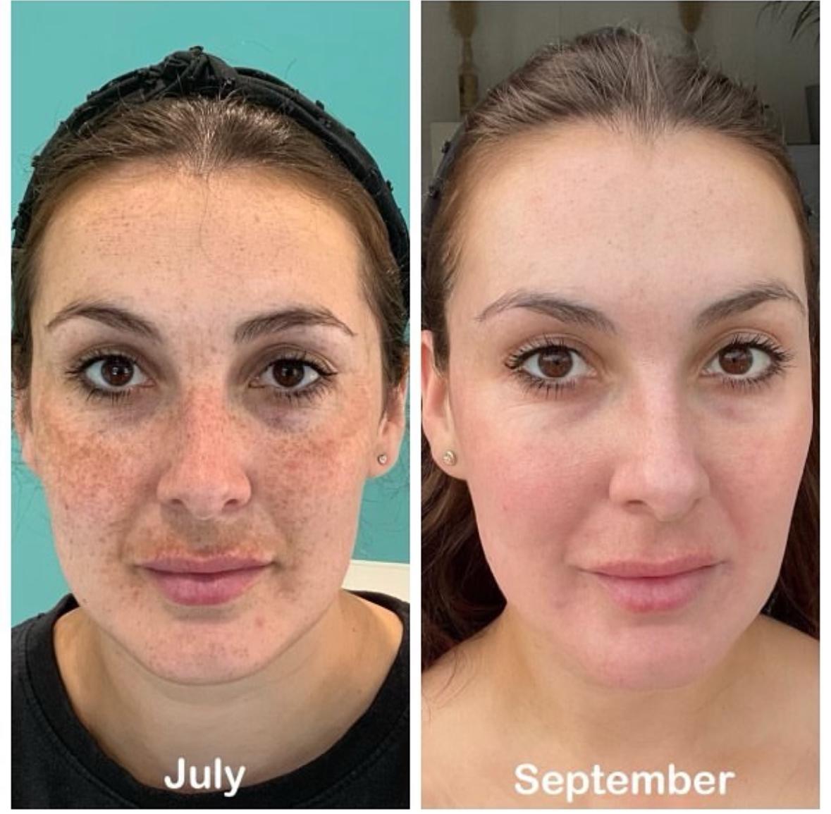 Chemical Peels 20% OFF!