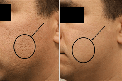 Microneedling With PDRN