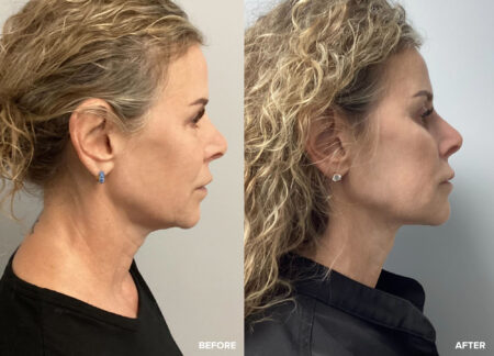 Tempsure Envi Face & Neck Tightening
