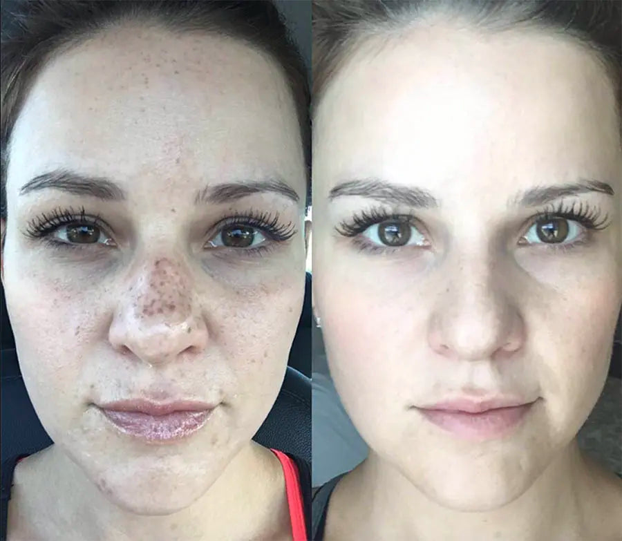 Microneedling With PRP: Package of Three