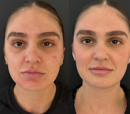 Microneedling With PDRN