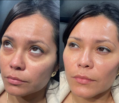PRP + Filler Undereye Package