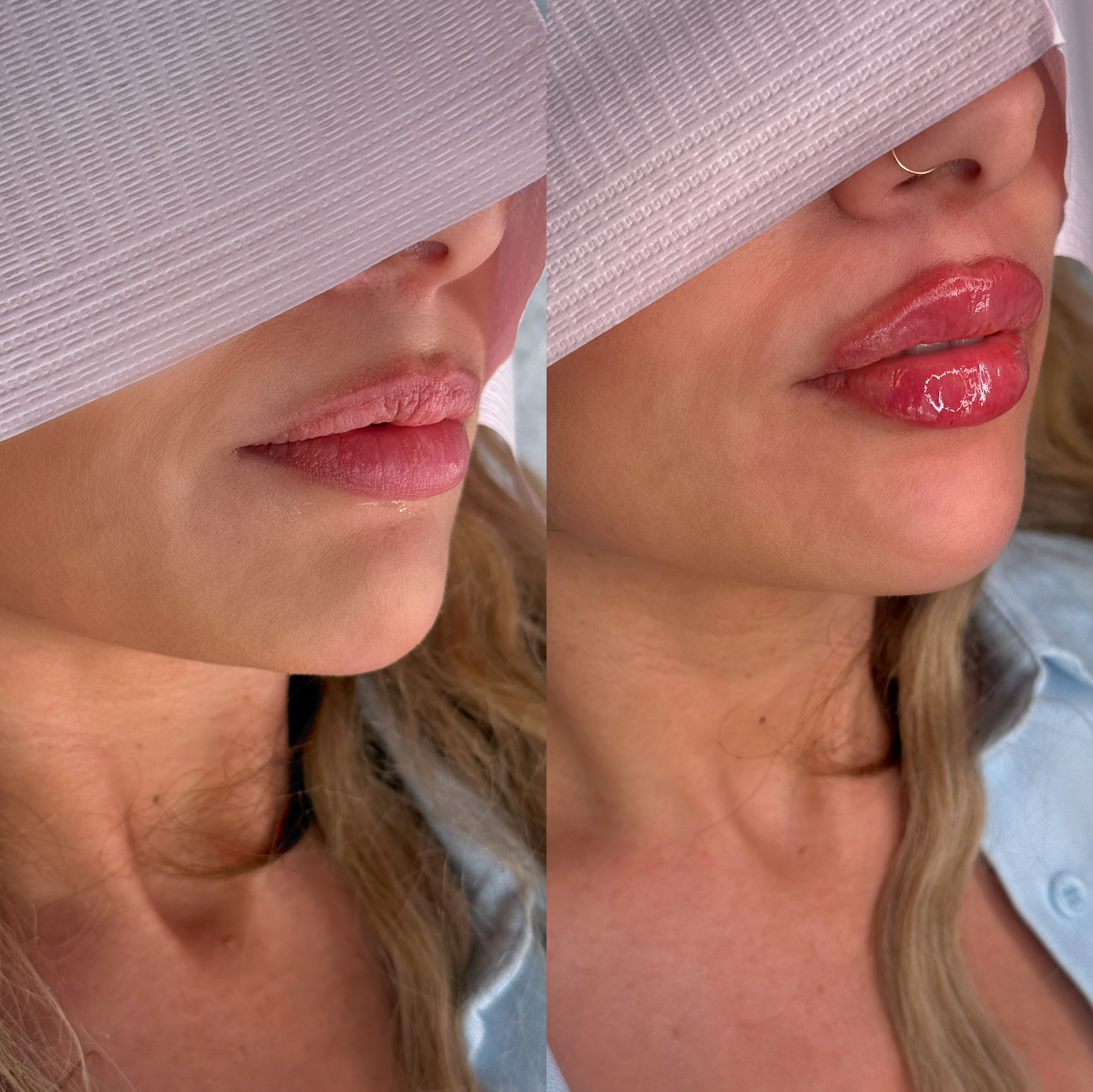 Lip Filler Full Syringe