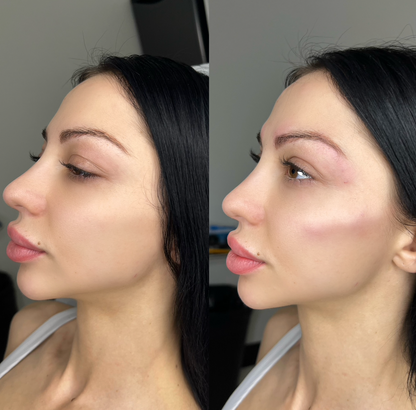 Firm Filler 1 Syringe