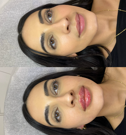 Lip Filler Full Syringe