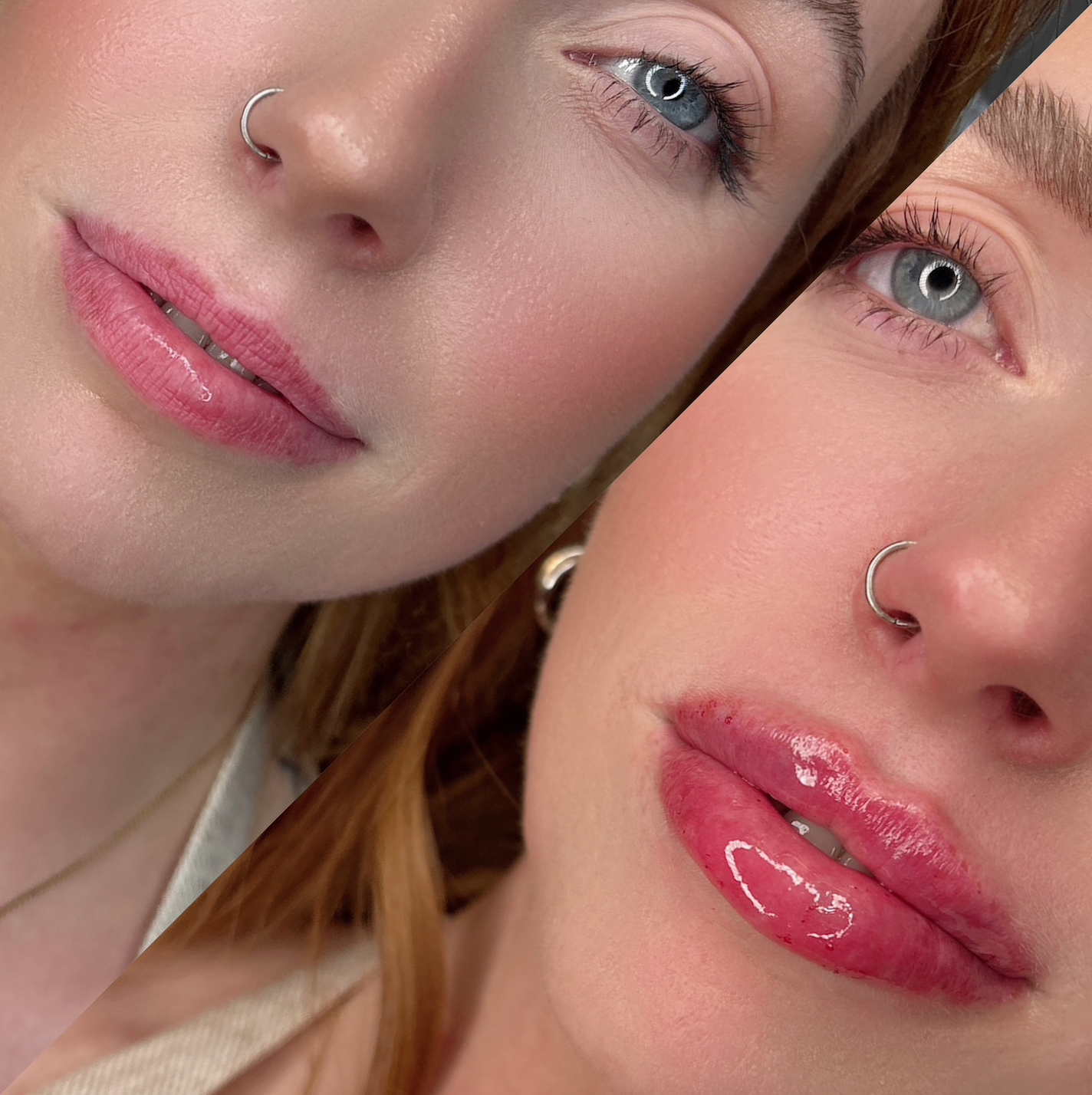 Lip Filler 1/2 Syringe
