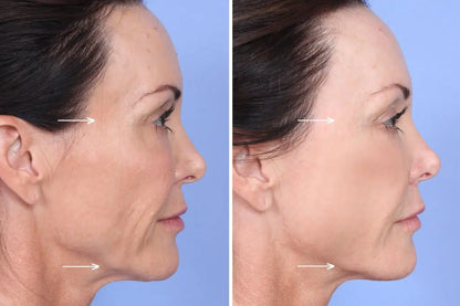 PermaLift (Sculptra)