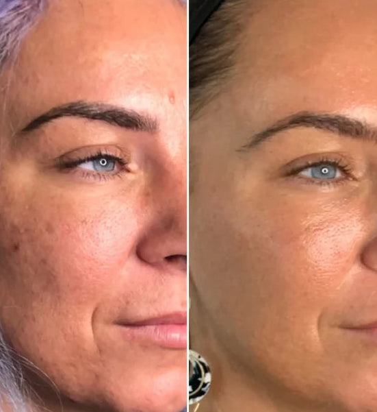 Microneedling