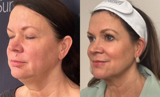 Tempsure Envi Full Face Tightening