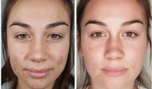 Microneedling With PermaFiltr