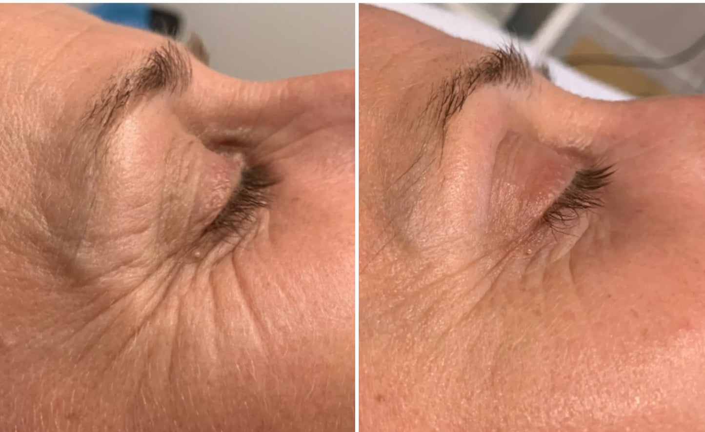 Microneedling With PermaFiltr